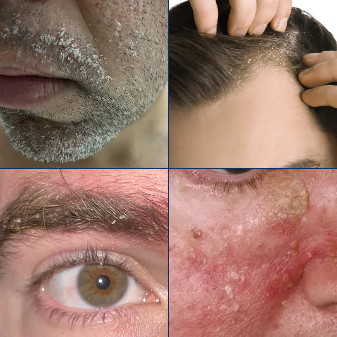 Collage of skin conditions including acne, dandruff, and dry skin.